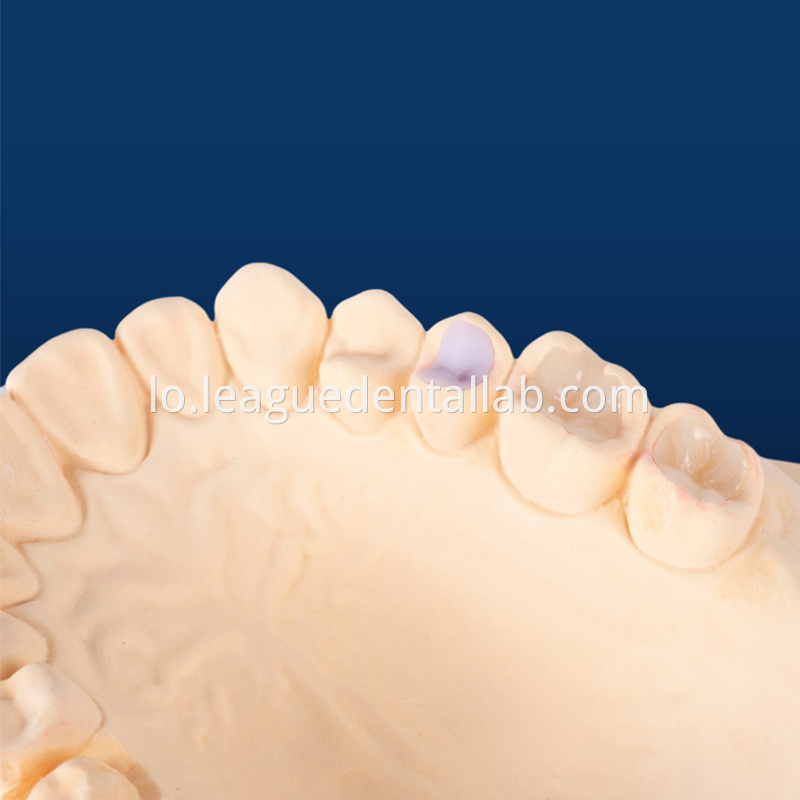 IPS Empress,Emax Onlay,Emax onlay,Emax Veneer,Lithium disilicate